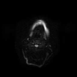 File:Carcinoma ex-pleomorphic adenoma of parotid (Radiopaedia 28383-28627 Ax DWI B-500 GE 44).jpg