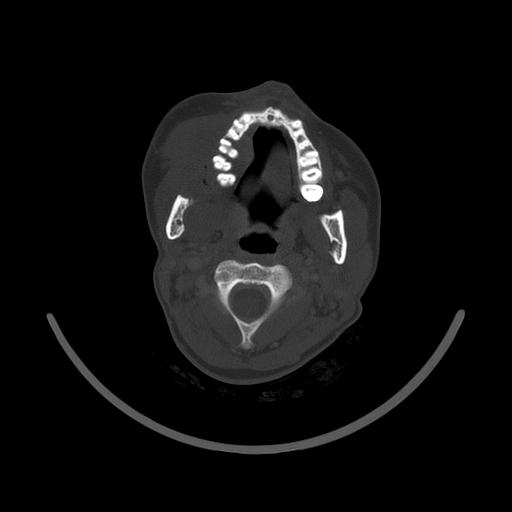 Carcinoma of the maxillary antrum (Radiopaedia 53805-59888 Axial bone window 78).jpg