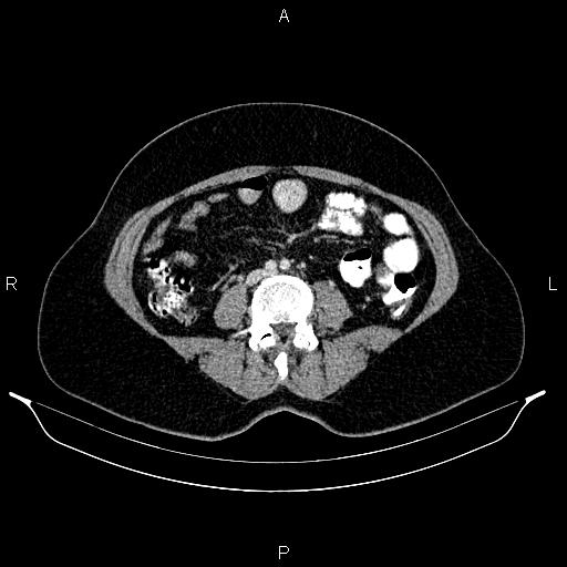 Carcinoma of uterine cervix (Radiopaedia 85861-101700 A 54).jpg