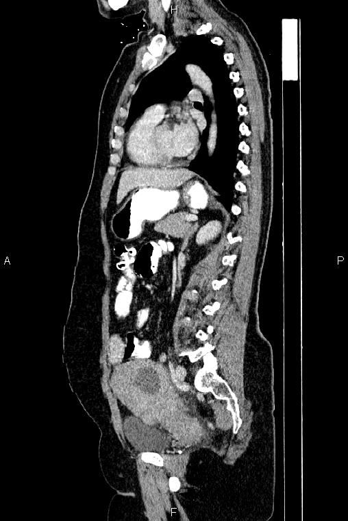 Carcinoma of uterine cervix (Radiopaedia 85861-101700 D 51).jpg