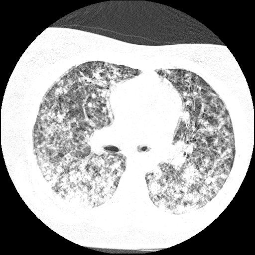 Cardiac angiosarcoma (Radiopaedia 66010-75181 Axial lung window 53).jpg