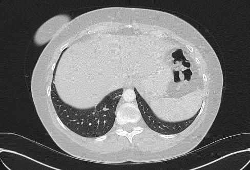 Cardiac sarcoidosis (Radiopaedia 74548-85534 Axial lung window 78).jpg