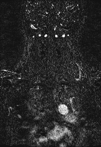 File:Carotid artery dissection (Radiopaedia 28441-28689 Coronal MRA 79).jpg