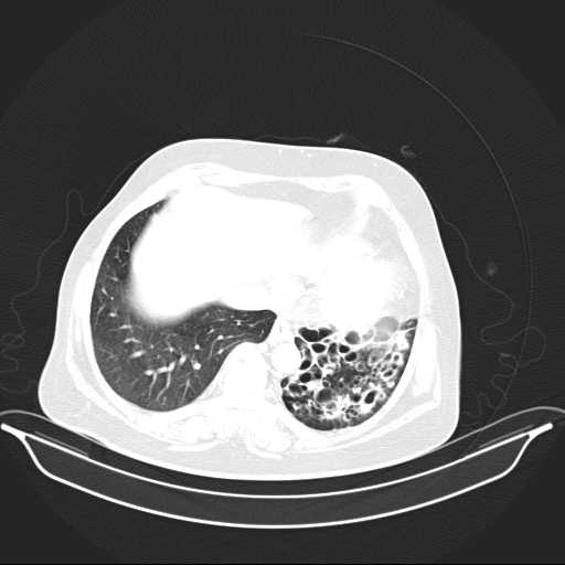 File:Carotid body tumor (Radiopaedia 21021-20948 Axial lung window 34).jpg