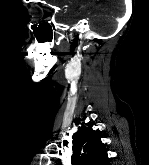File:Carotid body tumor (Radiopaedia 39845-42300 D 31).jpg
