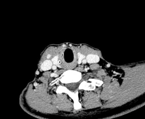 Carotid body tumor (Radiopaedia 61750-69757 Axial Post contrast 91).jpg