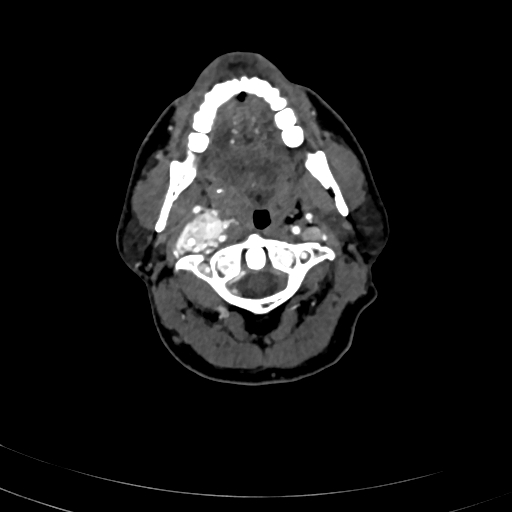 Carotid body tumor (Radiopaedia 83615-98727 A 40).jpg