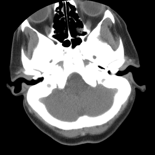 File:Carotid body tumor (paraganglioma) (Radiopaedia 38586-40729 A 4).jpg