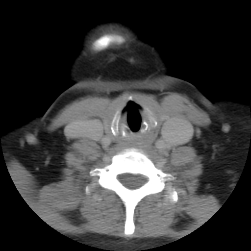 File:Carotid body tumor (paraganglioma) (Radiopaedia 38586-40729 A 60).jpg