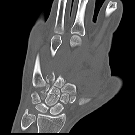 File:Carpo-metacarpal fracture-dislocations with hamatum split fracture (Radiopaedia 18482-18343 Coronal bone window 10).jpg