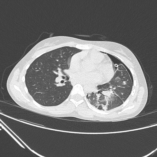 File:Catamenial pneumothorax (Radiopaedia 27946-28197 lung window 88).jpg