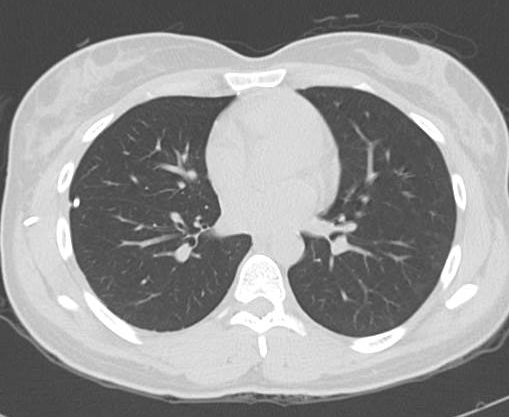 File:Catamenial pneumothorax (Radiopaedia 54382-60600 Axial 20).png