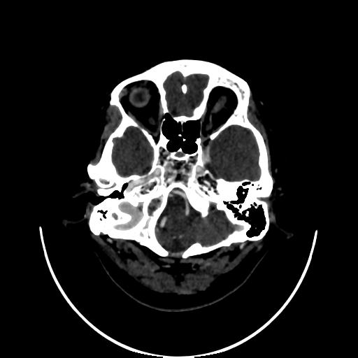 Cavernoma with developmental venous anomaly (Radiopaedia 22470-22506 C 16).jpg