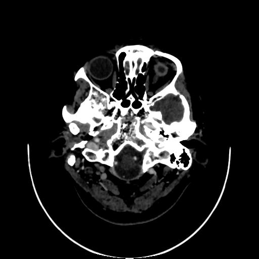 Cavernoma with developmental venous anomaly (Radiopaedia 22470-22506 C 6).jpg