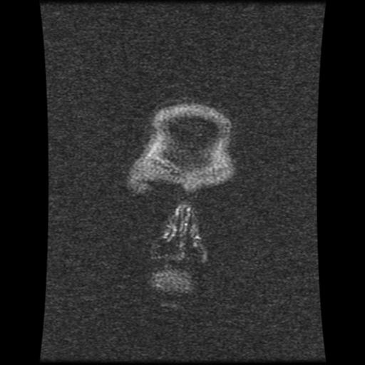 File:Cavernoma with developmental venous anomaly (Radiopaedia 22470-22507 MRV 123).jpg