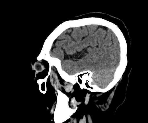 Cavernous hemangioma of the cerebellar falx (Radiopaedia 73025-83723 B 69).jpg