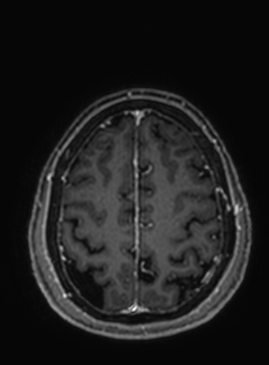 Cavernous hemangioma of the cerebellar falx (Radiopaedia 73025-83724 Axial T1 C+ 79).jpg