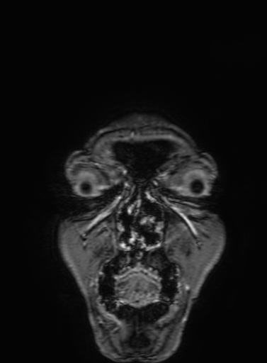 Cavernous hemangioma of the cerebellar falx (Radiopaedia 73025-83724 Coronal T1 C+ 10).jpg