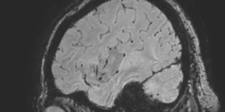 Cavernous hemangioma of the cerebellar falx (Radiopaedia 73025-83724 Sagittal BOLD 38).jpg