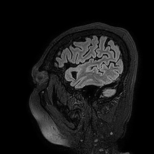 File:Cavernous hemangioma of the cerebellar falx (Radiopaedia 73025-83724 Sagittal FLAIR 23).jpg