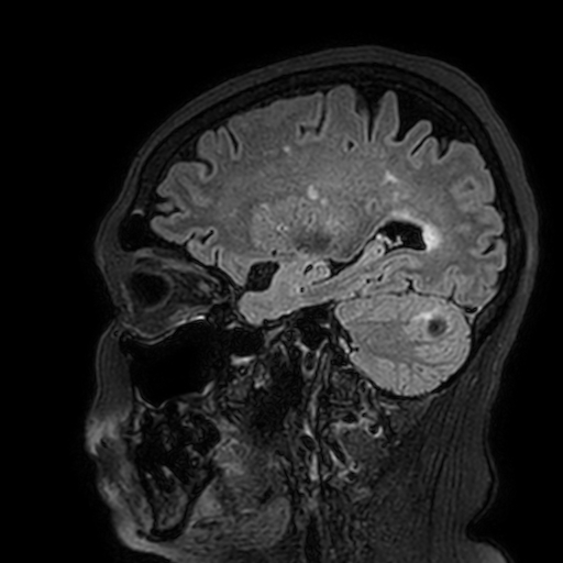 Cavernous hemangioma of the cerebellar falx (Radiopaedia 73025-83724 Sagittal FLAIR 62).jpg