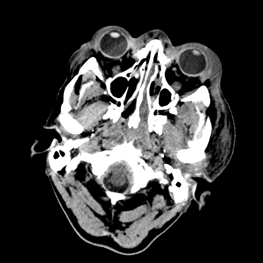 File:Cavernous sinus thrombosis (Radiopaedia 10619-11078 Axial non-contrast 2).jpg