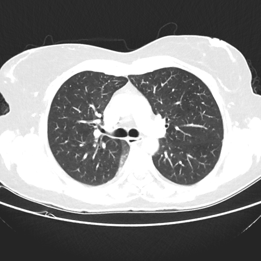File:Cavitating lung mass - squamous cell carcinoma (Radiopaedia 48047-52854 Axial lung window 20).png