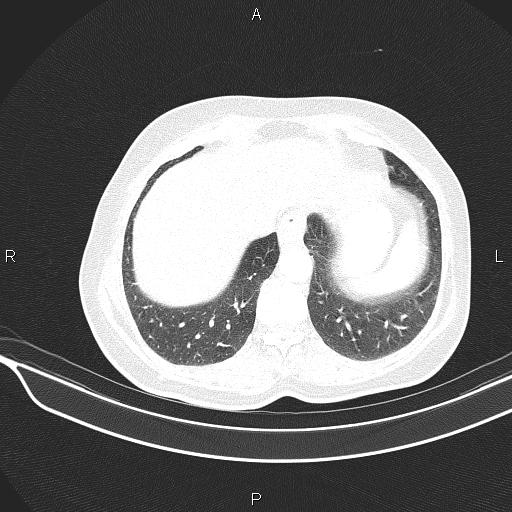 Cecal cancer (Radiopaedia 85610-101358 Axial lung window 52).jpg