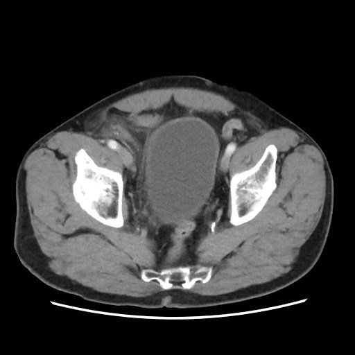 Cecal mass causing appendicitis (Radiopaedia 59207-66531 A 77).jpg