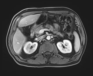Cecal mass causing appendicitis (Radiopaedia 59207-66532 T1 C+ PV phase 52).jpg