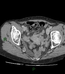 Cecal volvulus (Radiopaedia 86741-102900 A 118).jpg