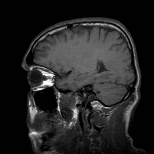 File:Central-variant posterior reversible encephalopathy syndrome (PRES) (Radiopaedia 43880-47359 Sagittal T1 17).jpg