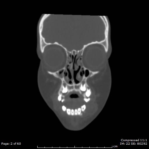 Central giant cell granuloma (Radiopaedia 45612-49754 Coronal bone window 2).jpg