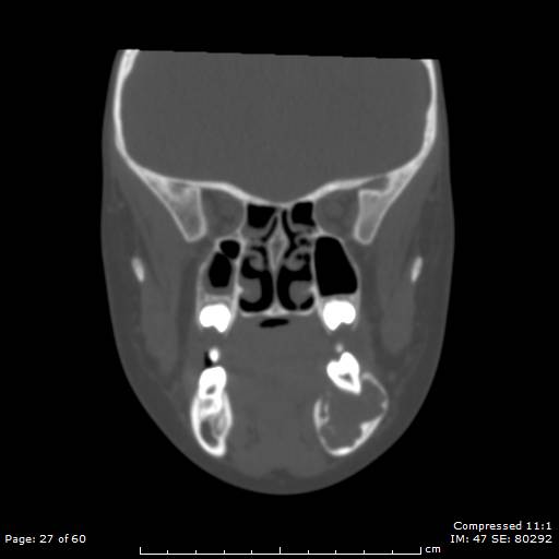Central giant cell granuloma (Radiopaedia 45612-49754 Coronal bone window 27).jpg