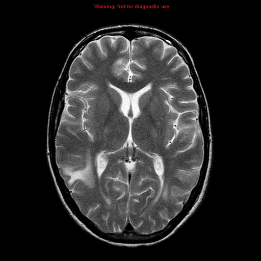 File:Central nervous system vasculitis (Radiopaedia 8410-9235 Axial T2 13).jpg