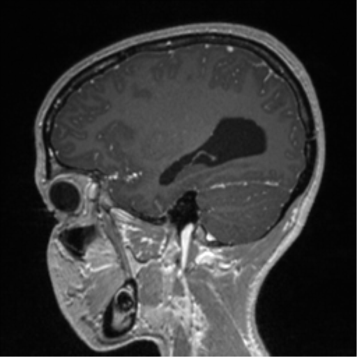 File:Central neurocytoma (Radiopaedia 37664-39557 Sagittal T1 C+ 29).png