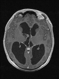 Central neurocytoma (Radiopaedia 56690-63469 Axial T1 C+ 79).jpg