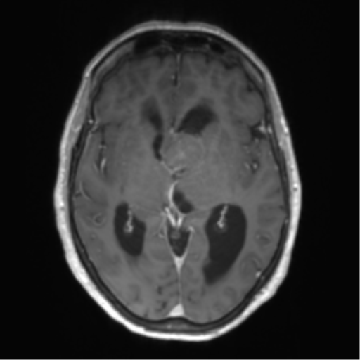 Central neurocytoma (Radiopaedia 65317-74345 Axial T1 C+ 25).png