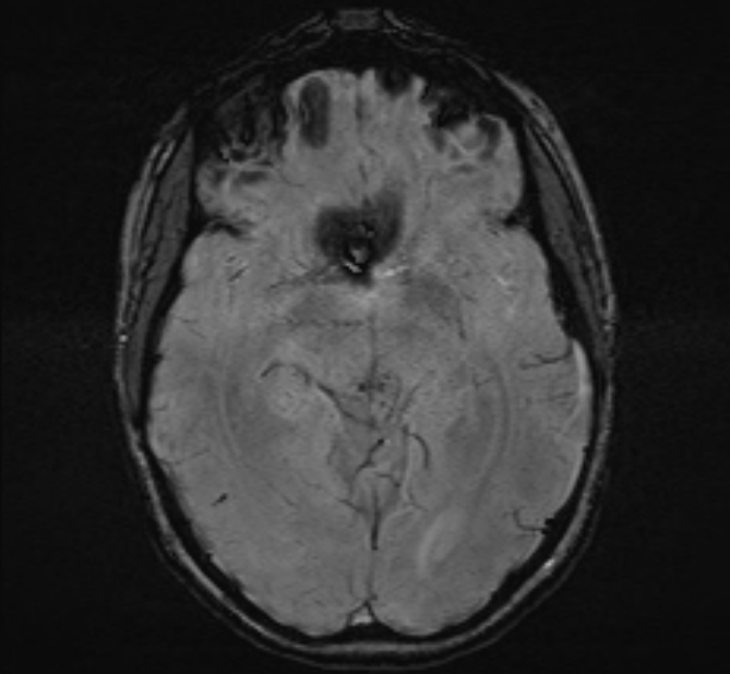 Central neurocytoma (Radiopaedia 70263-80336 Axial SWI 24).jpg