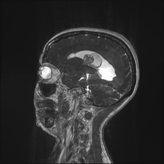 Central neurocytoma (Radiopaedia 84497-99872 Sagittal CISS 13).jpg