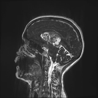 File:Central neurocytoma (Radiopaedia 84497-99872 Sagittal CISS 35).jpg