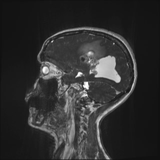 Central neurocytoma (Radiopaedia 84497-99872 Sagittal CISS 71).jpg