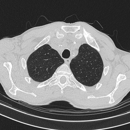Central venous catheter tip extravasation (Radiopaedia 82828-97113 Axial lung window 18).jpg