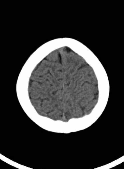 Cerebellar abscess (Radiopaedia 73727-84527 Axial non-contrast 57).jpg