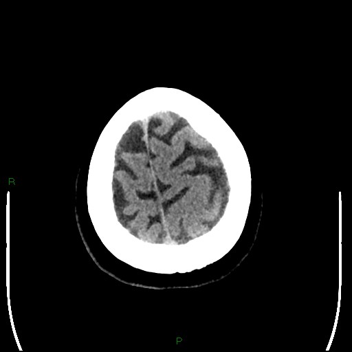 Cerebellar abscess (Radiopaedia 78135-90671 Axial non-contrast 100).jpg