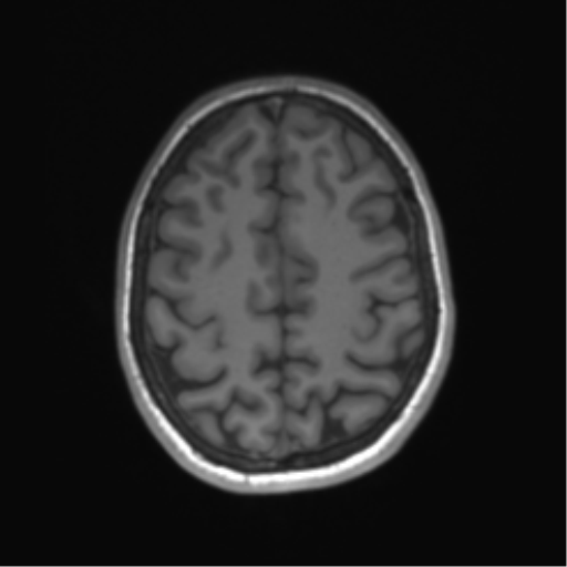 Cerebellar agenesis with hypoplastic pons (pontocerebellar hypoplasia) (Radiopaedia 57224-64138 Axial T1 59).png