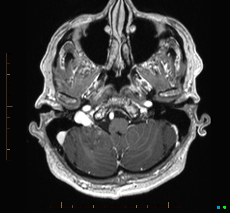 Cerebellar gangliocytoma (Radiopaedia 65377-74422 Axial T1 C+ 13).jpg