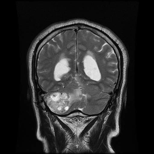 File:Cerebellar hemangioblastoma (Radiopaedia 88055-104622 Coronal T2 13).jpg