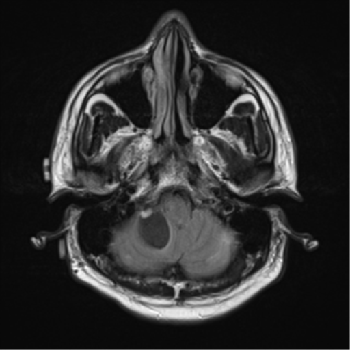 File:Cerebellar hemangioblastomas and pituitary adenoma (Radiopaedia 85490-101176 Axial FLAIR 5).png