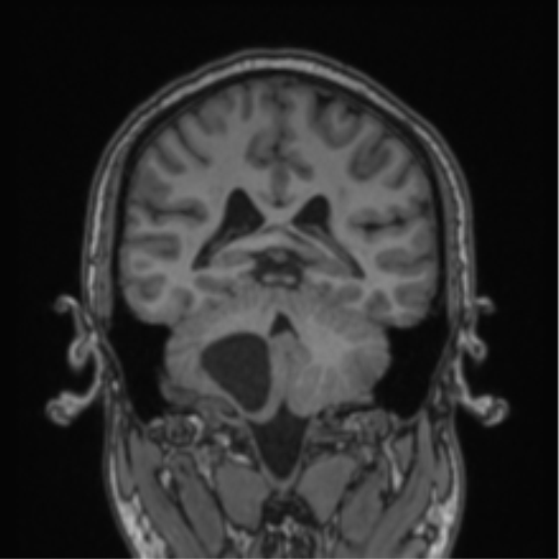 File:Cerebellar hemangioblastomas and pituitary adenoma (Radiopaedia 85490-101176 Coronal T1 38).png